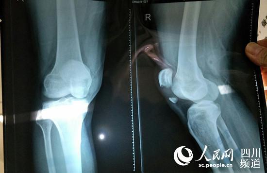 扒手拼命反抗追捕 致成都民警摔倒髕骨骨折(圖)