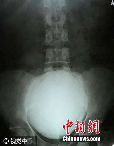 印度男子腹痛入院 膀胱取出1.5公斤巨型結石