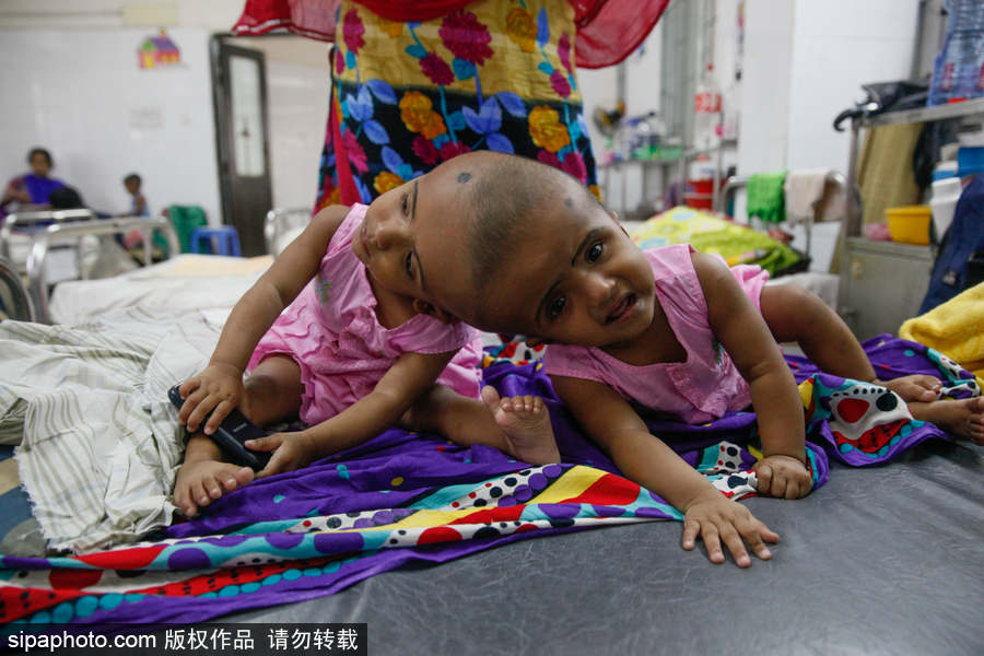 孟加拉國連頭嬰兒 至少到兩歲才能進行手術