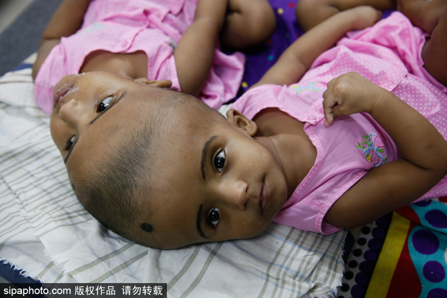 孟加拉國連頭嬰兒 至少到兩歲才能進行手術